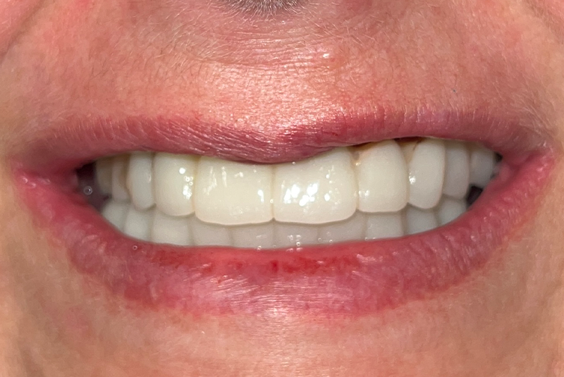 full arch dental implants case 0 after