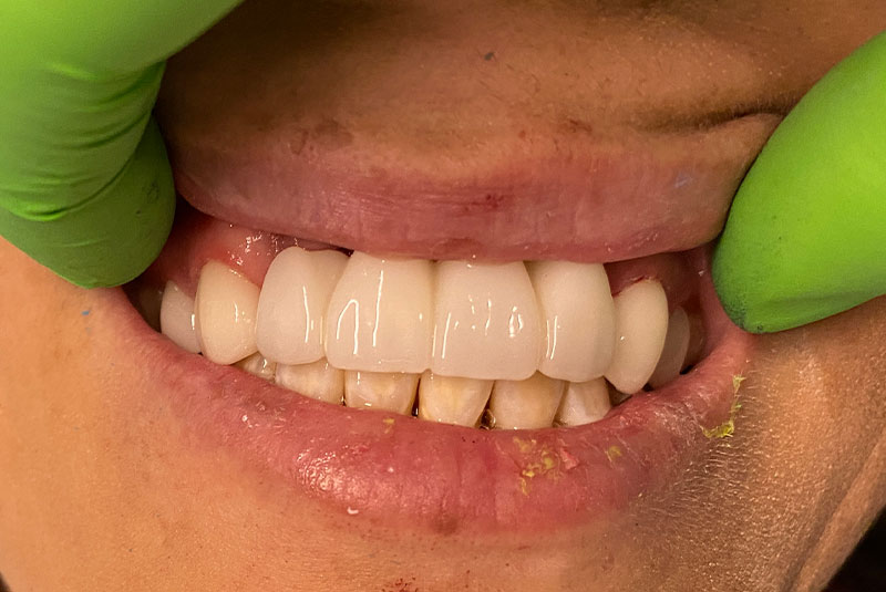 full arch dental implants case 1 after