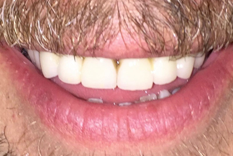 full arch dental implants case 2 after