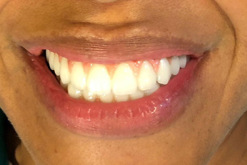 full arch dental implants case 3 after
