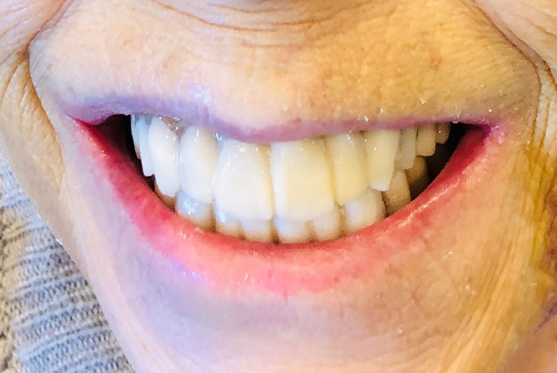 full arch dental implants case 4 after