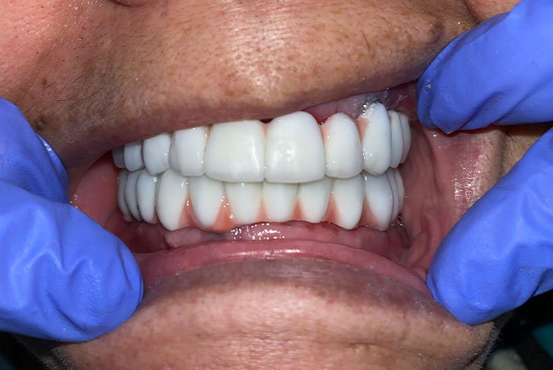 full arch dental implants case 5 after