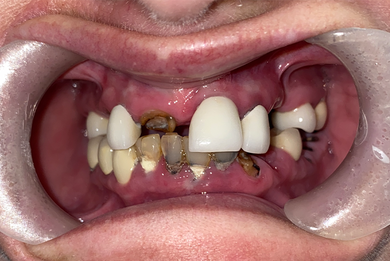 full arch dental implants case 0 before