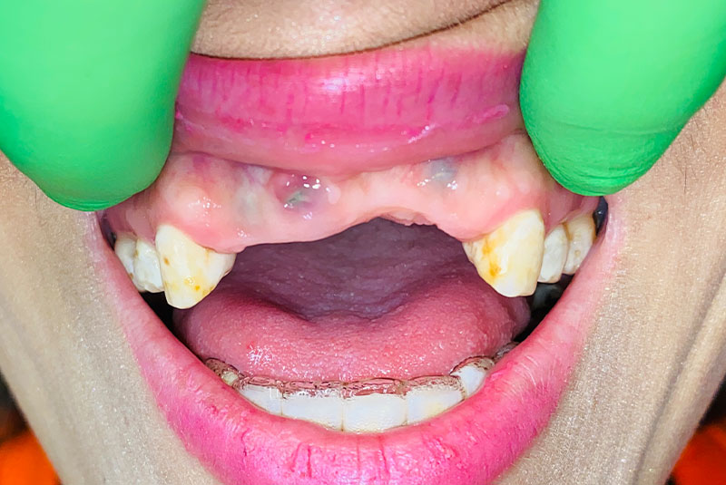 full arch dental implants case 1 before