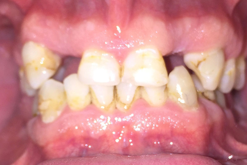 full arch dental implants case 2 before