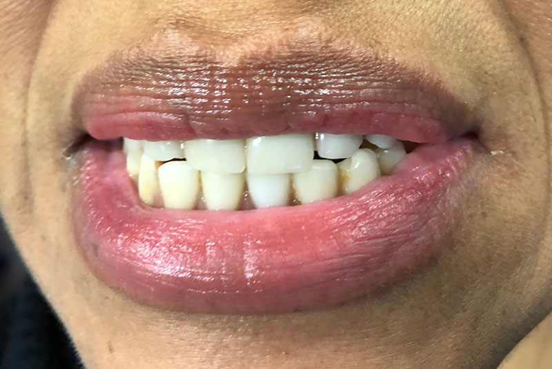 full arch dental implants case 3 before