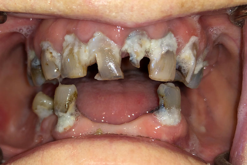 full arch dental implants case 4 before