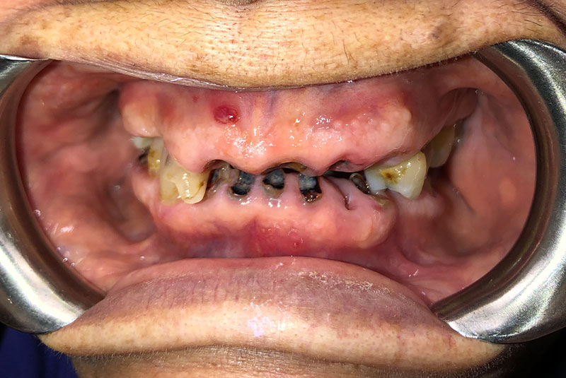 full arch dental implants case 5 before