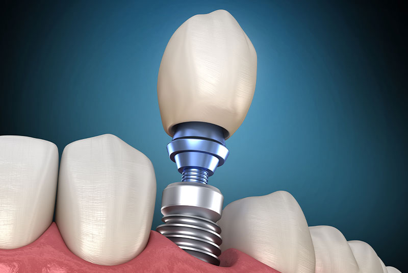 dental implant 3d