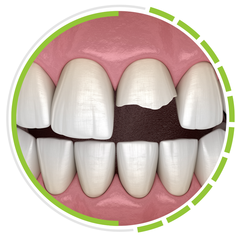 cracked tooth