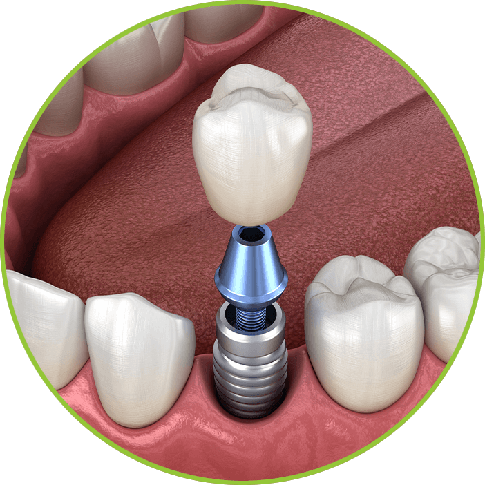 Dental Implant