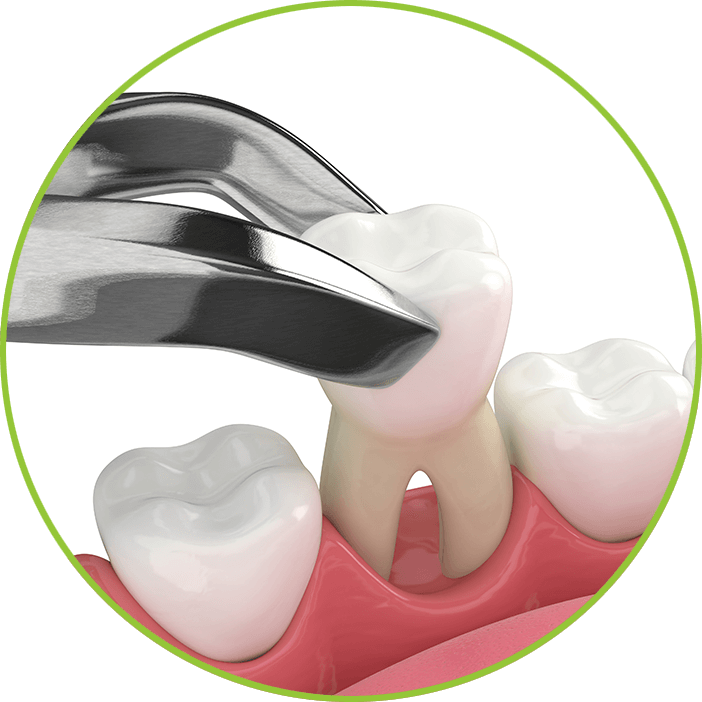 tooth extraction