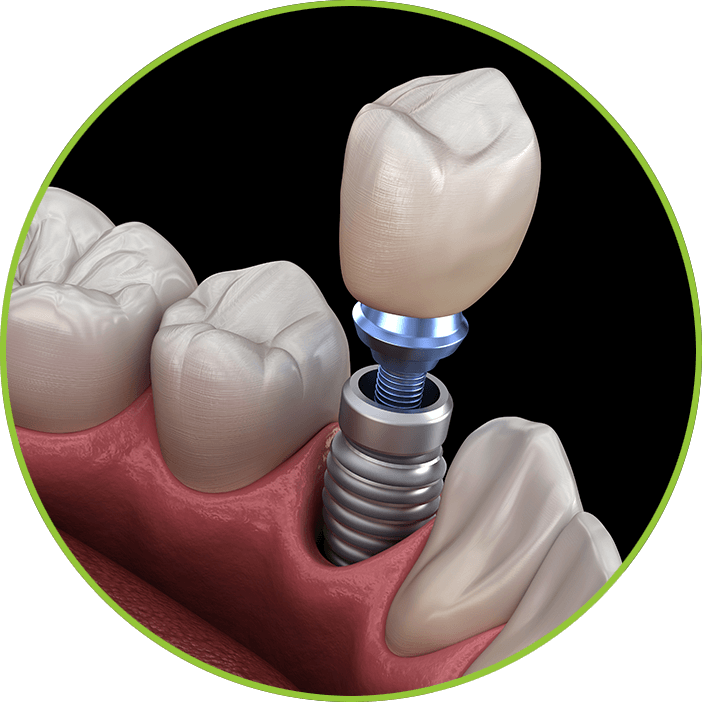 dental implant