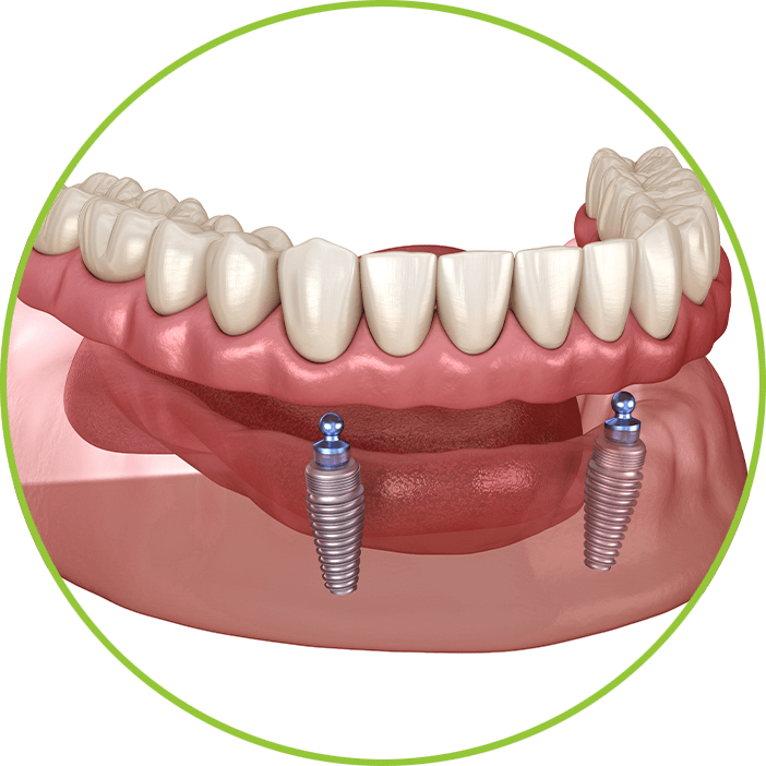 Implant Dentures