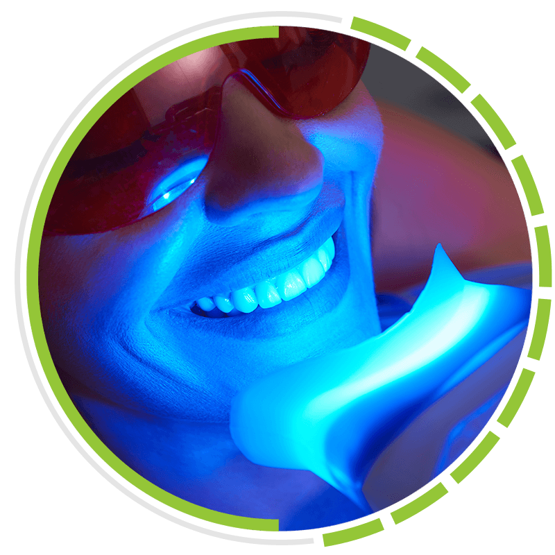 Teeth whitening