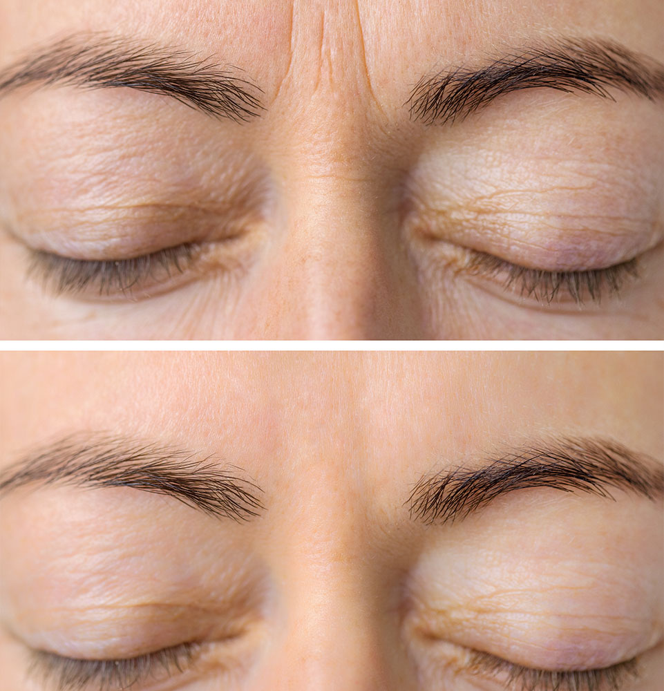 before after of botox