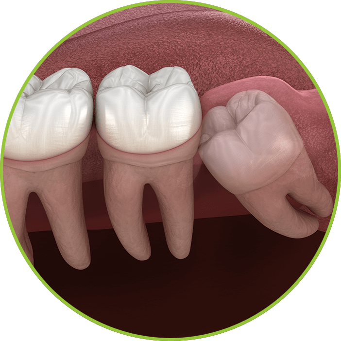 Wisdom tooth