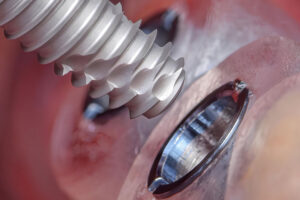 Close-up view of a titanium dental implant being inserted into the jawbone, illustrating osseointegration and implant threading detail.