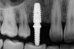 Close up x-ray of a patient's mouth showing a titanium dental implant fused to the jaw bone, with the abutment visible. No text on image.