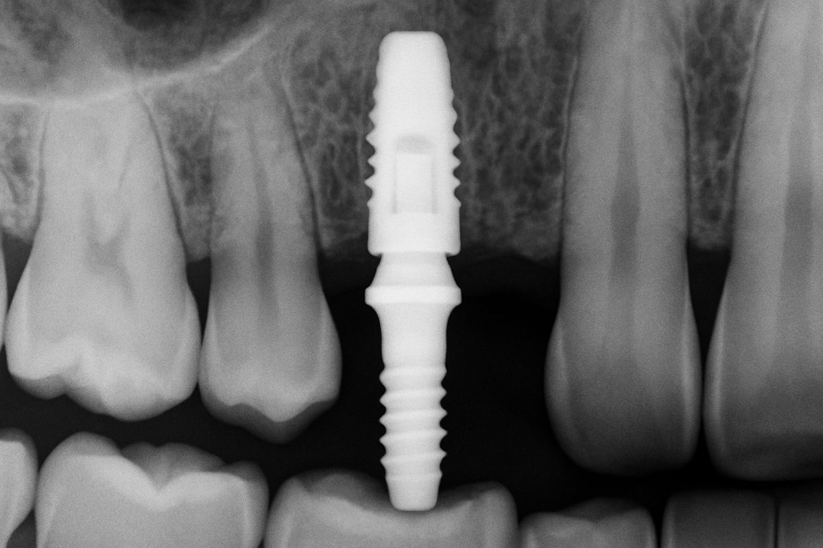 Close up x-ray of a patient's mouth showing a titanium dental implant fused to the jaw bone, with the abutment visible. No text on image.
